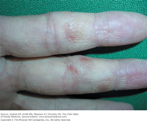 Irritant Contact Dermatitis Hand