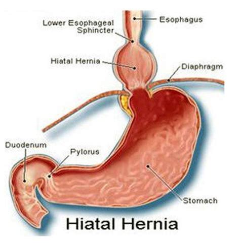 Hiatal Hernia Pictures Symptoms Treatment Recovery Time Surgery Hubpages
