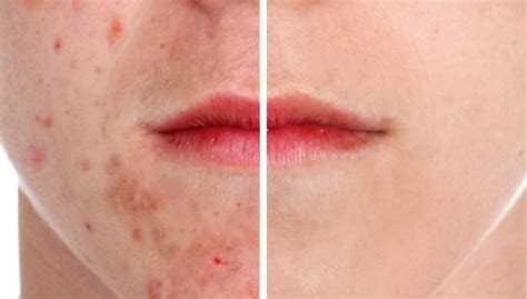 Maybe you would like to learn more about one of these? 8 Tips Penjagaan Untuk Muka Breakout - Aqua Beauty