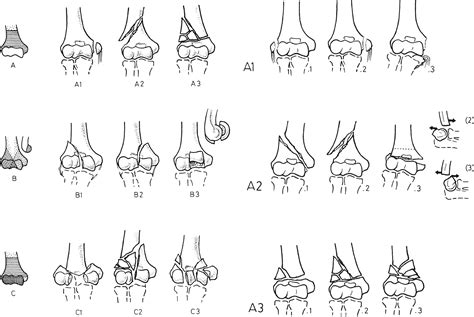 Classification Of Fractures Of The Distal Humerus A Ao Classification My Xxx Hot Girl