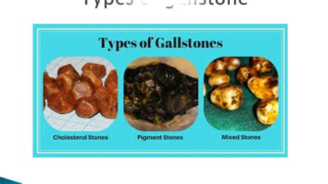 Kidney Stone And Gallstone Youtube