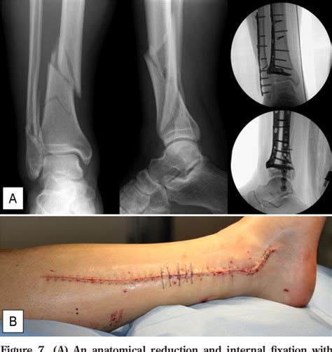 Figure 1 From The Direct Lateral Approach To The Distal Tibia And