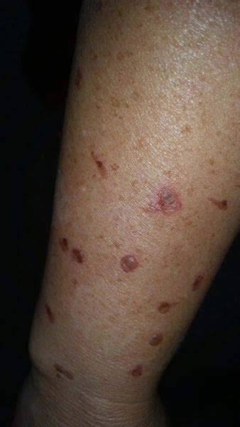 My Derm Used Liquid Nitrogen On Age Spots On My Arm And Hand 5 Days Ago