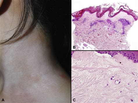 Lichen Planus And Lichenoid Dermatoses Journal Of The American