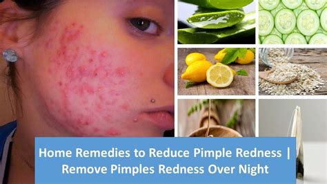 Home Remedies To Reduce Pimple Redness Remove Pimples Redness Over