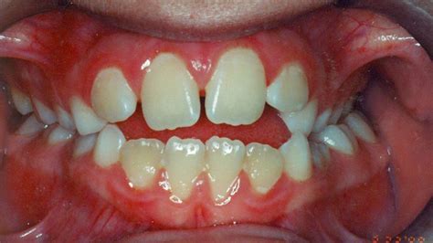 Tongue Thrust Msdental