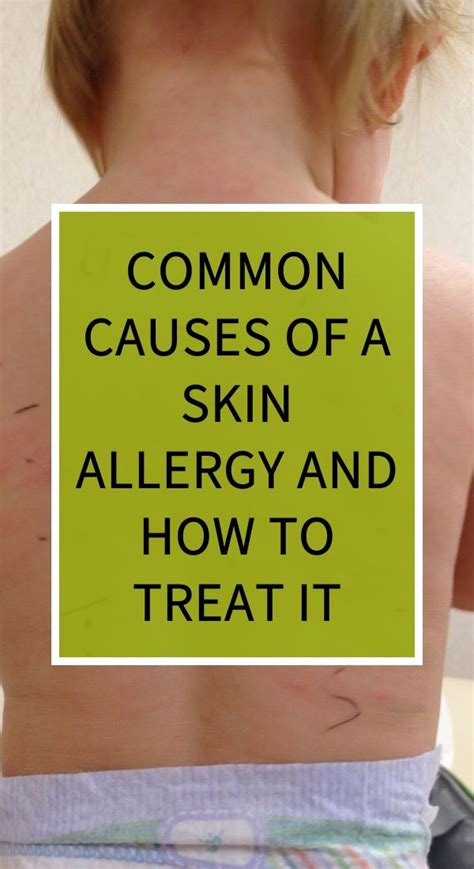 Common Causes Of A Skin Allergy And How To Treat It Skin Allergies Skin Allergy Symptoms