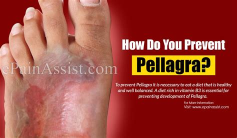 How Do You Prevent Pellagra