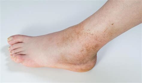 Cause Of Swollen Ankles In The Morning Causes Of Swelling In Lower Legs What To Do With