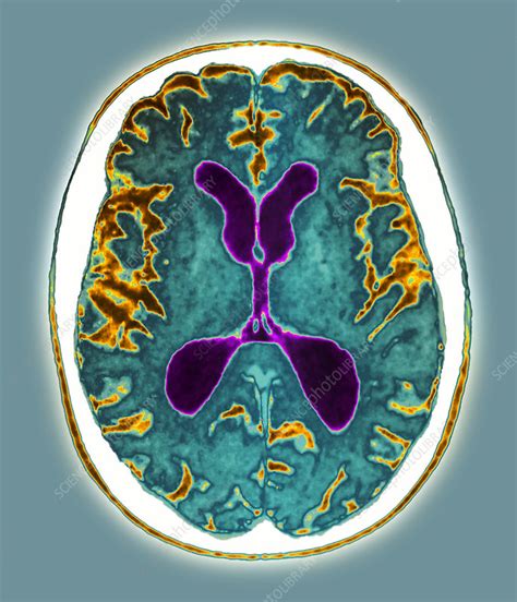 Alzheimers Disease Mri Scan Stock Image M1080688 Science Photo