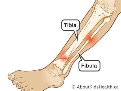 Fibula, little has been published about the incidence, epidemiology and treatment of double our study indicates that bifocal fractures involving the. Lower leg fracture