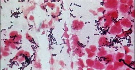 Flesh Eating Bacteria Kills Nc Woman Cbs News