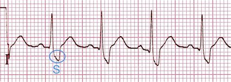 Post Vsd Closure Rbbb Short And Long Term Outcome After
