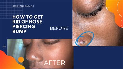 how to get rid of nose piercing bump 5 min fix youtube