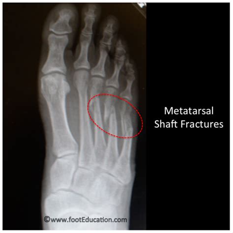 Metatarsal Shaft Fractures Footeducation