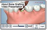 Pictures of Bone Graft Recovery