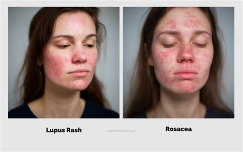 Lupus Rash Vs Rosacea Whats The Difference 2023