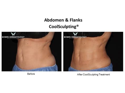 Coolsculpting Before And After Photos Coolslim