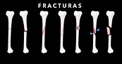 Fracturas - Ortopedista en Tijuana. Síntomas, Causas y Tratamiento