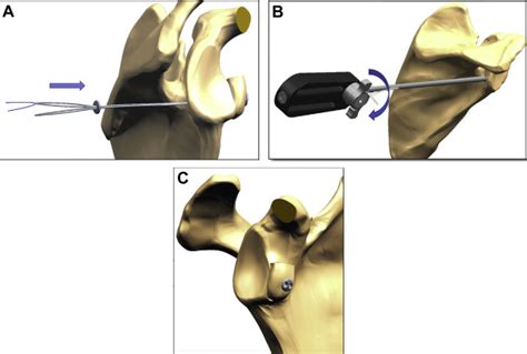 Tensioning Device Increases Coracoid Bone Block Healing Rates In