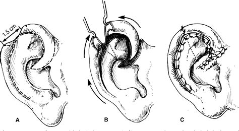 Ear Deformities Otoplasty And Ear Reconstruction Semantic Scholar