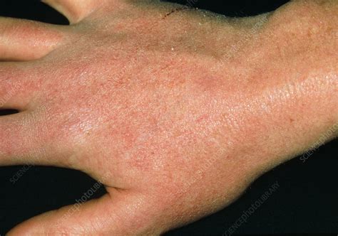 Dry Skin Reaction On Hand Due To Anti Acne Drug Stock