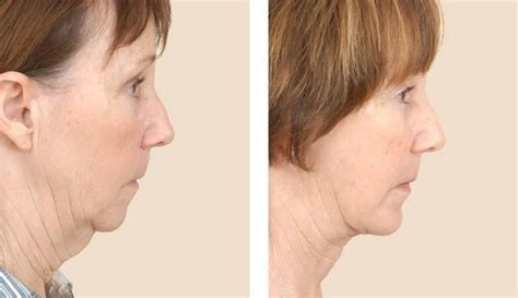 Chin Implant Surgery Recovery Types And Risks