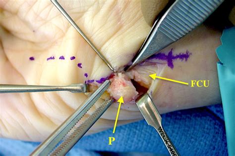 Pisiform Fractures Hand Surgery Source