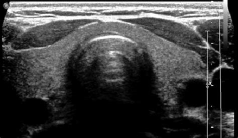 Normal Thyroid Gland Transverse Ultrasound Through The Neck Shows That