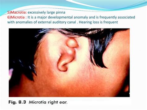 Ppt Diseases Of External Ear Powerpoint Presentation Free Download