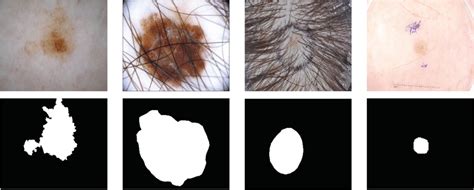 Some Examples Of Skin Lesion Images In The Isic Dataset The First Download Scientific