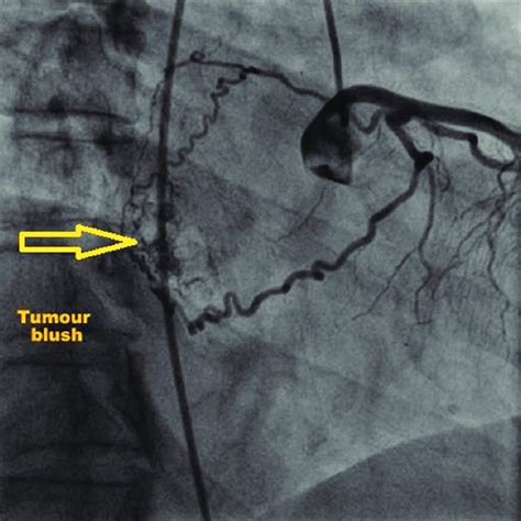 Right Anterior Oblique View Showing Tumor Blush Download Scientific