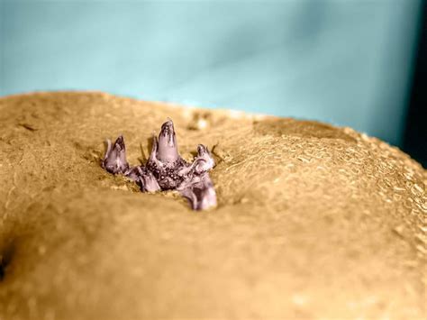 Anal Skin Tag Causes Removal Recovery And More