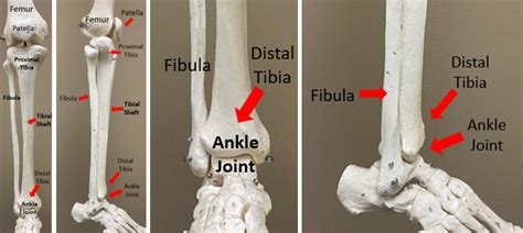 Pilon Fracture Orthopaedic Trauma Association Ota