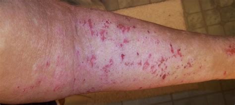 Why Topical Steroid Withdrawal May Be Causing Your Eczema Flare Ups