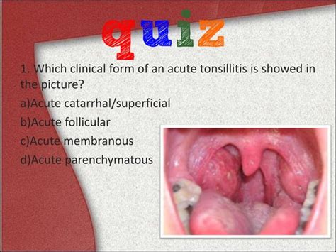 Acute Tonsillitis Ppt