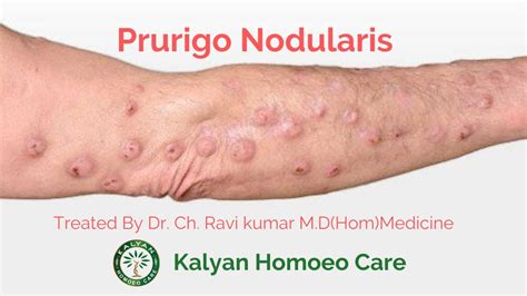 Best Homeopathy Treatment And Medicine For Prurigo Nodularis Dr