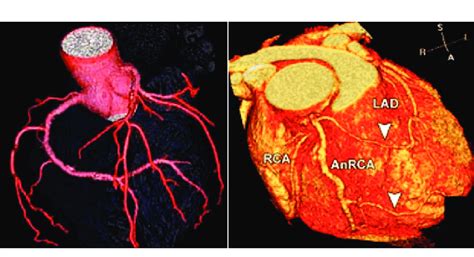 A Ct Coronary Angiogram A 3d Reconstruction Of A Cardiac Ct Scan