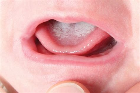 Oral Cancer On Tongue White Patches