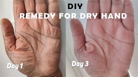 Home Remedy For Dry Hands Dry Skin Removal Easy Home Remedy For Dry