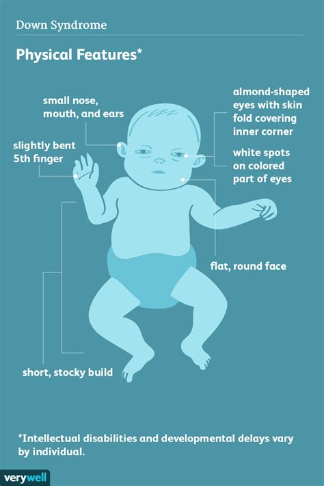 Symptoms And Characteristics Of Down Syndrome