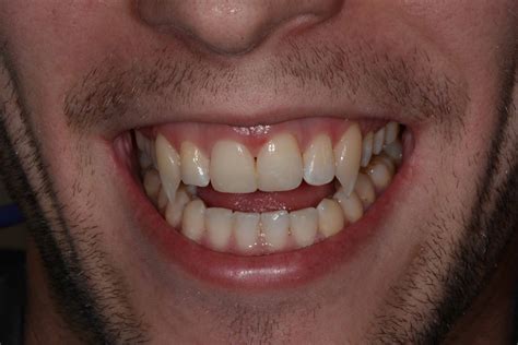 Made to order, please allow up to two weeks completion. Rolling Meadows Cosmetic Dentist Makes Vampires Happy ...