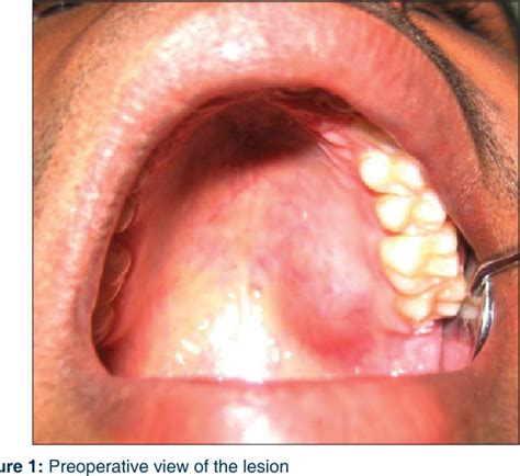 Figure From Schwannoma Of The Hard Palate A Case Report And Review My XXX Hot Girl