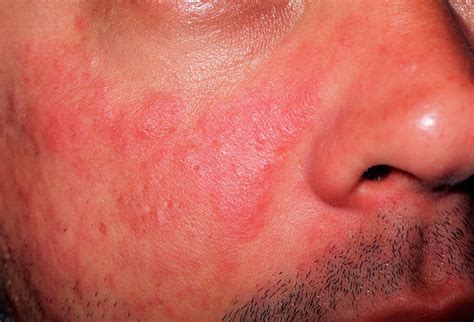 Lupus Skin Rash Photograph By Dr P Marazziscience Photo Library