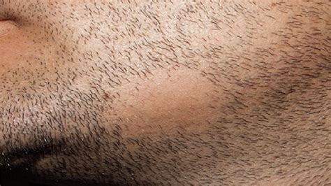 How To Get Rid Of Bald Spots On Beard Youtube