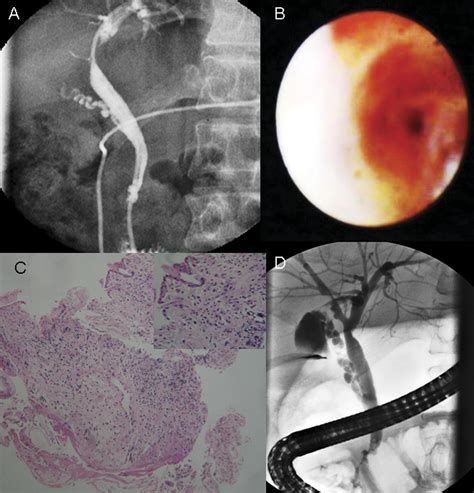 Role Of Single Operator Peroral Cholangioscopy In The Diagnosis Of