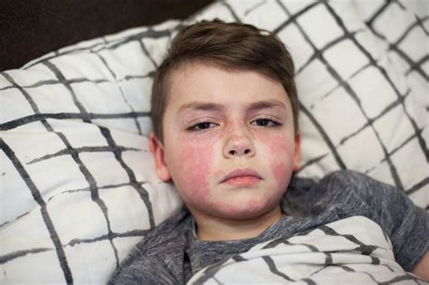 Parents Told Not To Panic Over Spike In Scarlet Fever Cases