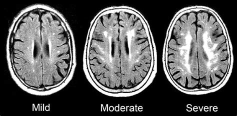Figure1 Brain Diseases White Matter Brain Scan