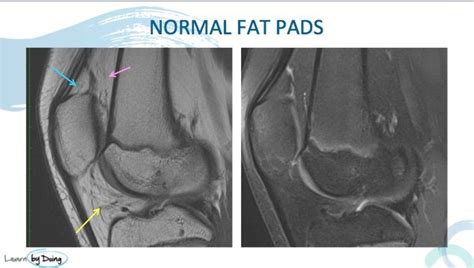 Knee Fat Pad Anatomy