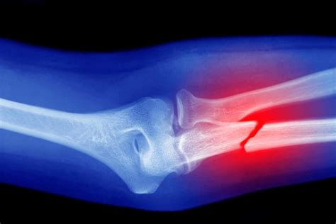 Types Of Broken Bones Treatment Healing Dr Sunny